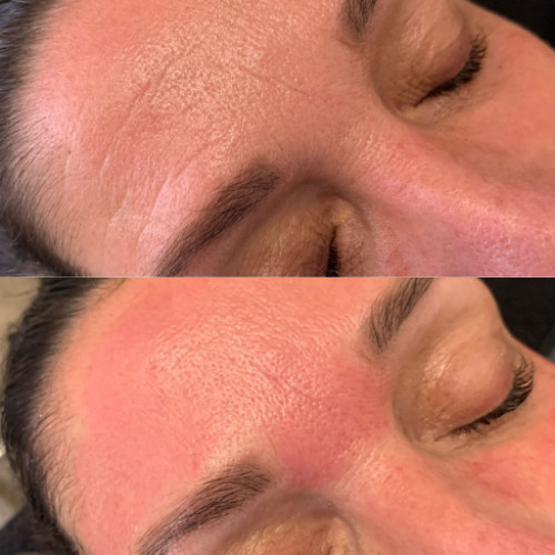 Huidverbetering en huidtheratie resultaat